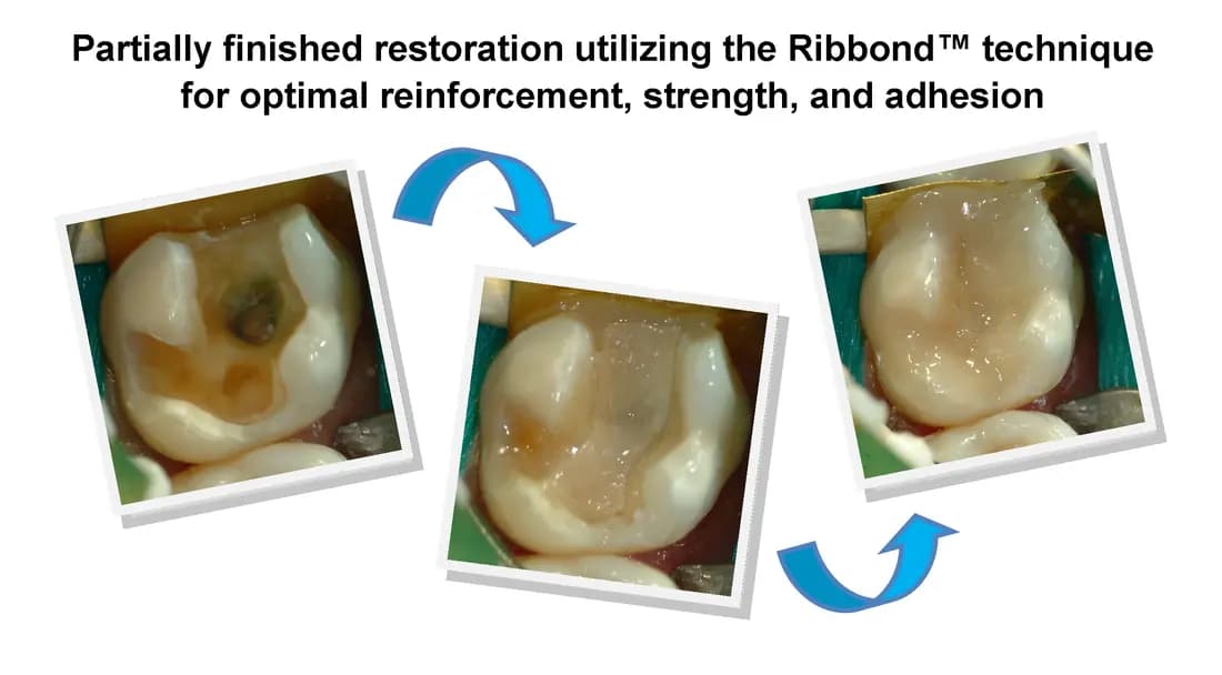 Ribbond technique