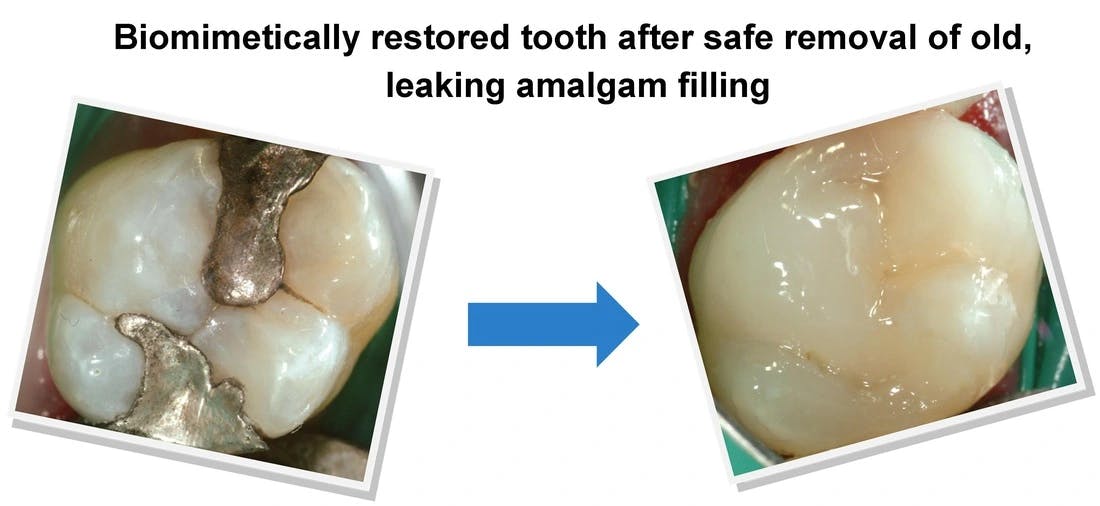 Fixed leaky amalgam filling